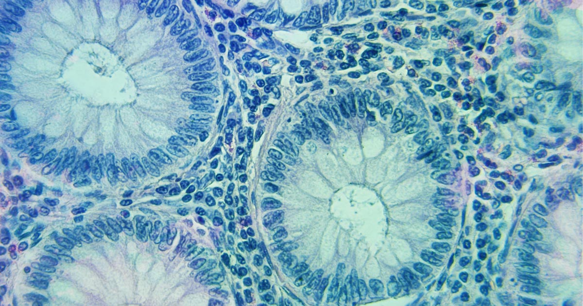 胃肠道癌细胞图像