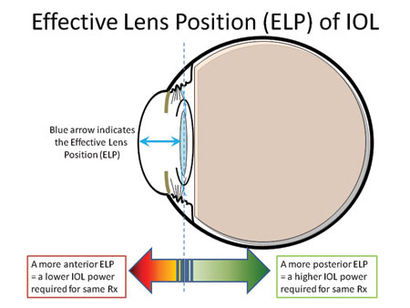 IOL的有效镜头位置决定了最终的术后折射。如果IOL被更向前放置，然后较低IOL功率将是必需的，而更后位将需要相同的术后折射更高的IOL功率。