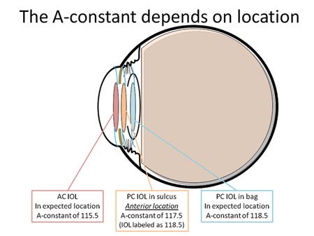 IOL的A常数取决于其在眼内的位置。更放置的透镜（例如前房IOL（红色）的透镜比后腔IOL的较低常数，其旨在置于囊袋（蓝色）中。当镜头放置在意想不到的位置，例如在睫状沟中，A常数将改变。